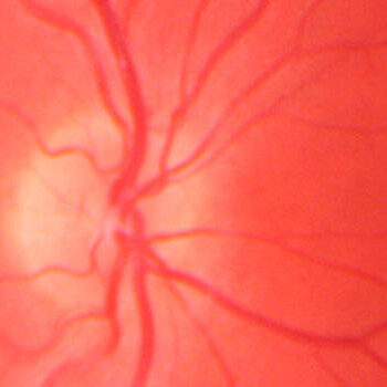 Retinal Imaging photograph